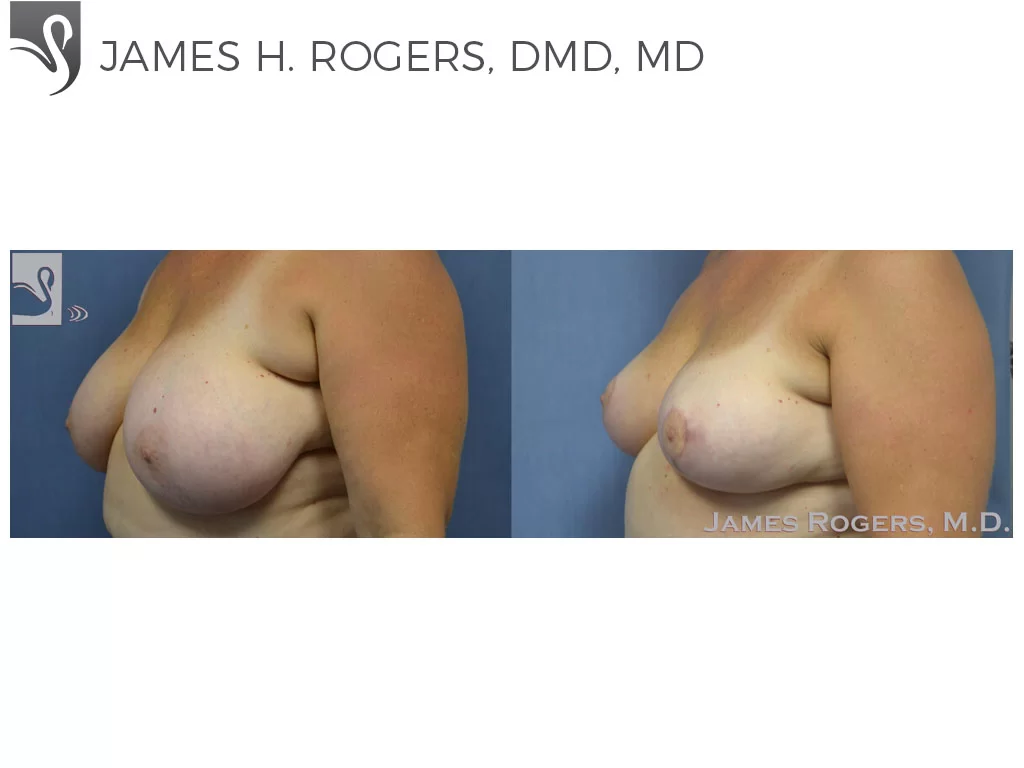 Before and After Image: Female Breast Reduction Case #53843 - left-front-oblique