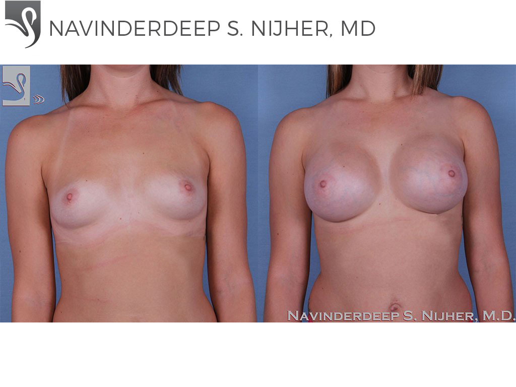 Before and After Image: Breast Augmentation Case #53845 - front