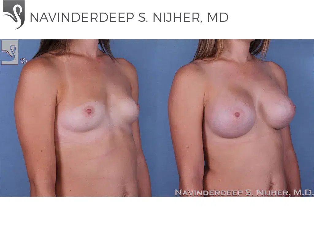 Before and After Image: Breast Augmentation Case #53845 - right-front-oblique