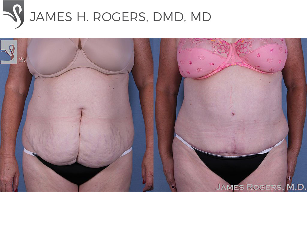 Before and After Image: Abdominoplasty (Tummy Tuck) Case #53893 - front