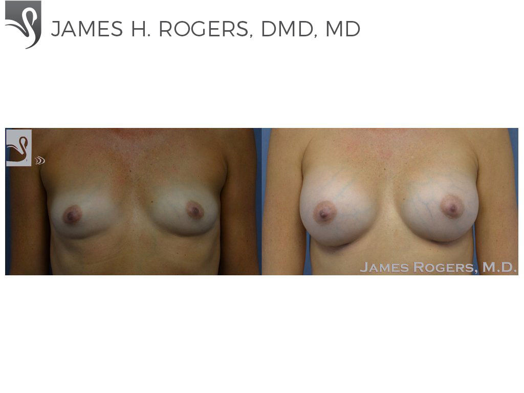 Before and After Image: Breast Augmentation Case #54028 - front
