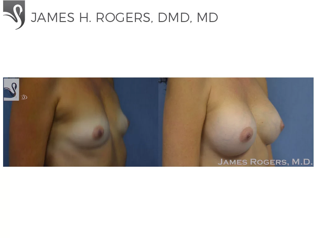 Before and After Image: Breast Augmentation Case #54028 - right-front-oblique