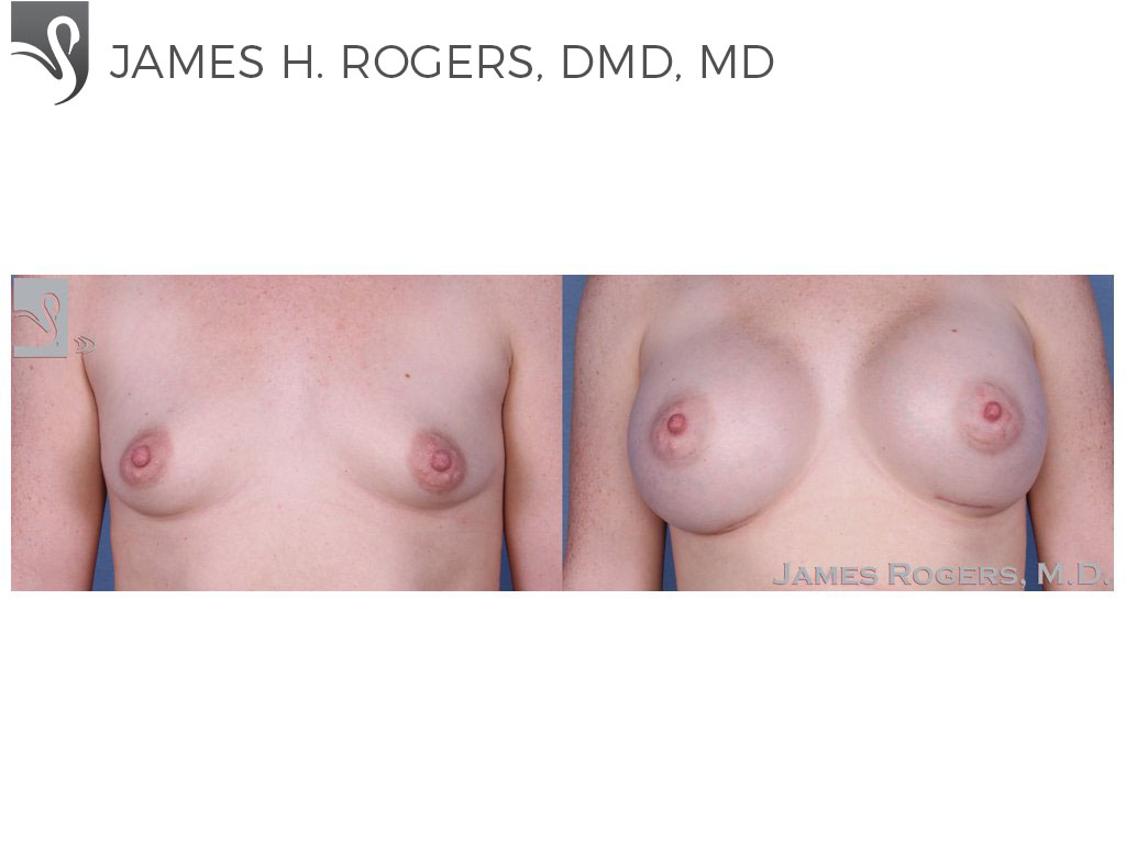 Before and After Image: Breast Augmentation Case #54396 - front