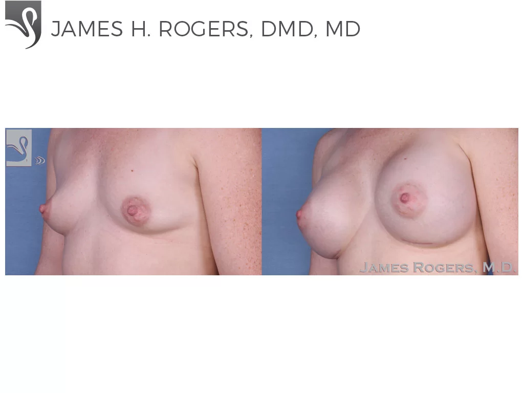 Before and After Image: Breast Augmentation Case #54396 - left-front-oblique