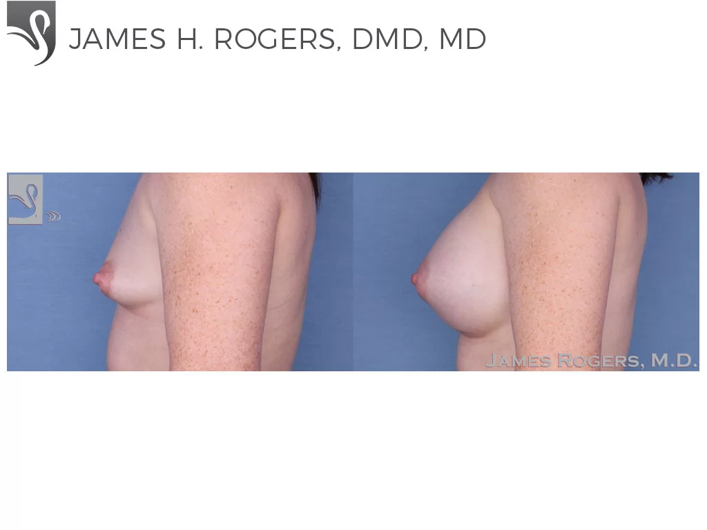 Before and After Image: Breast Augmentation Case #54396 - left-side