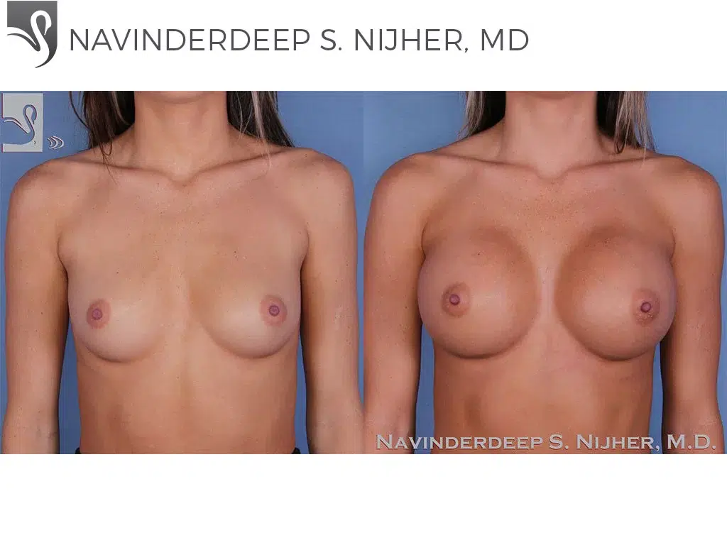 Before and After Image: Breast Augmentation Case #54398 - front