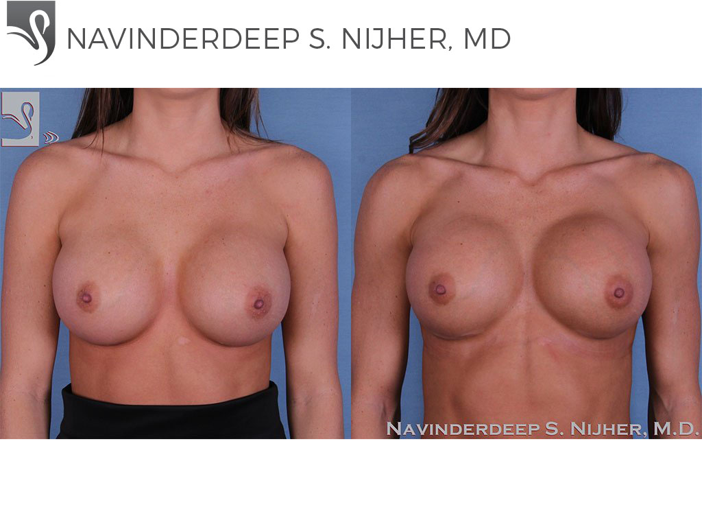 Before and After Image: Breast Revisions Case #54398 - front