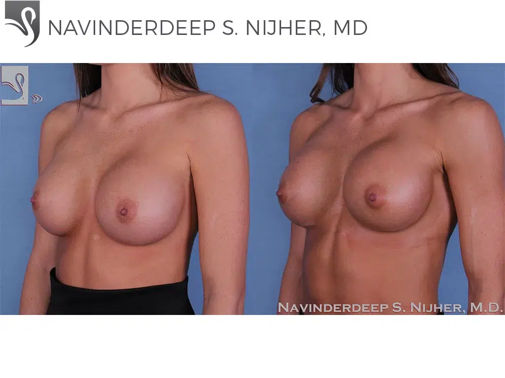 Before and After Image: Breast Revisions Case #54398 - left-front-oblique