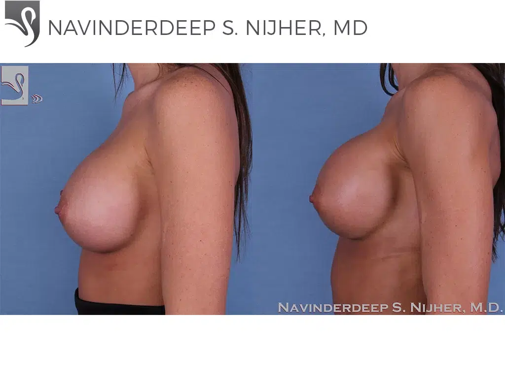 Before and After Image: Breast Revisions Case #54398 - left-side
