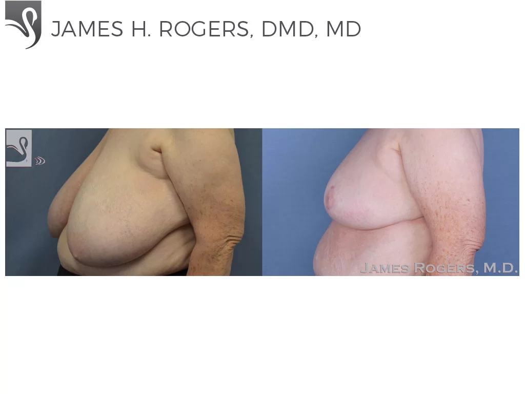 Before and After Image: Female Breast Reduction Case #54633 - left-side