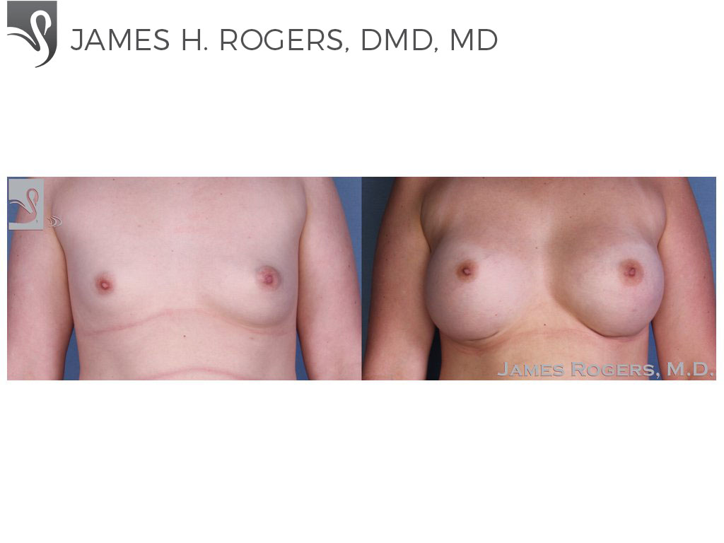 Before and After Image: Breast Augmentation Case #54860 - front