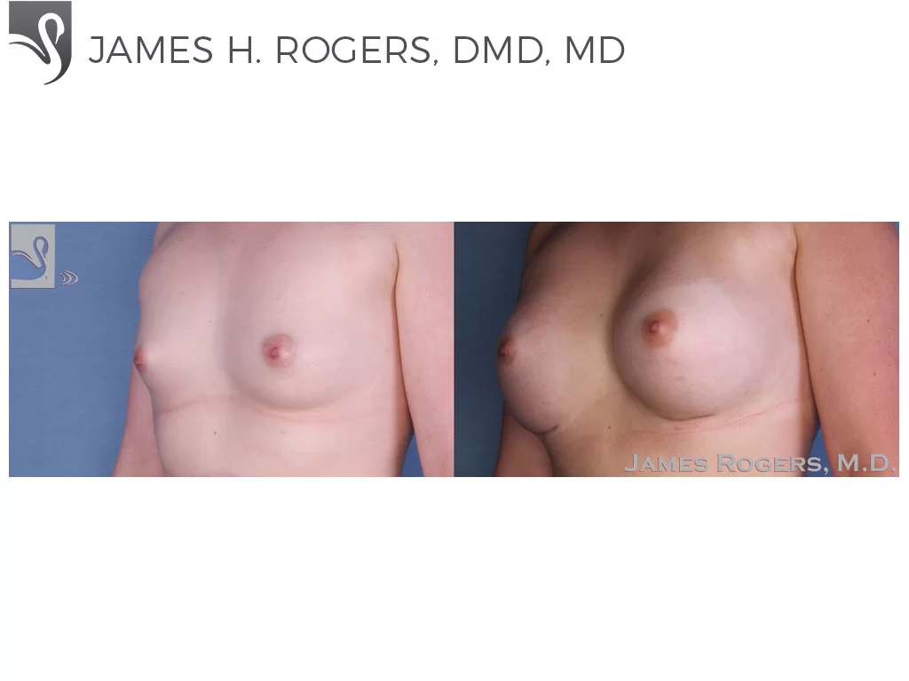 Before and After Image: Breast Augmentation Case #54860 - left-front-oblique