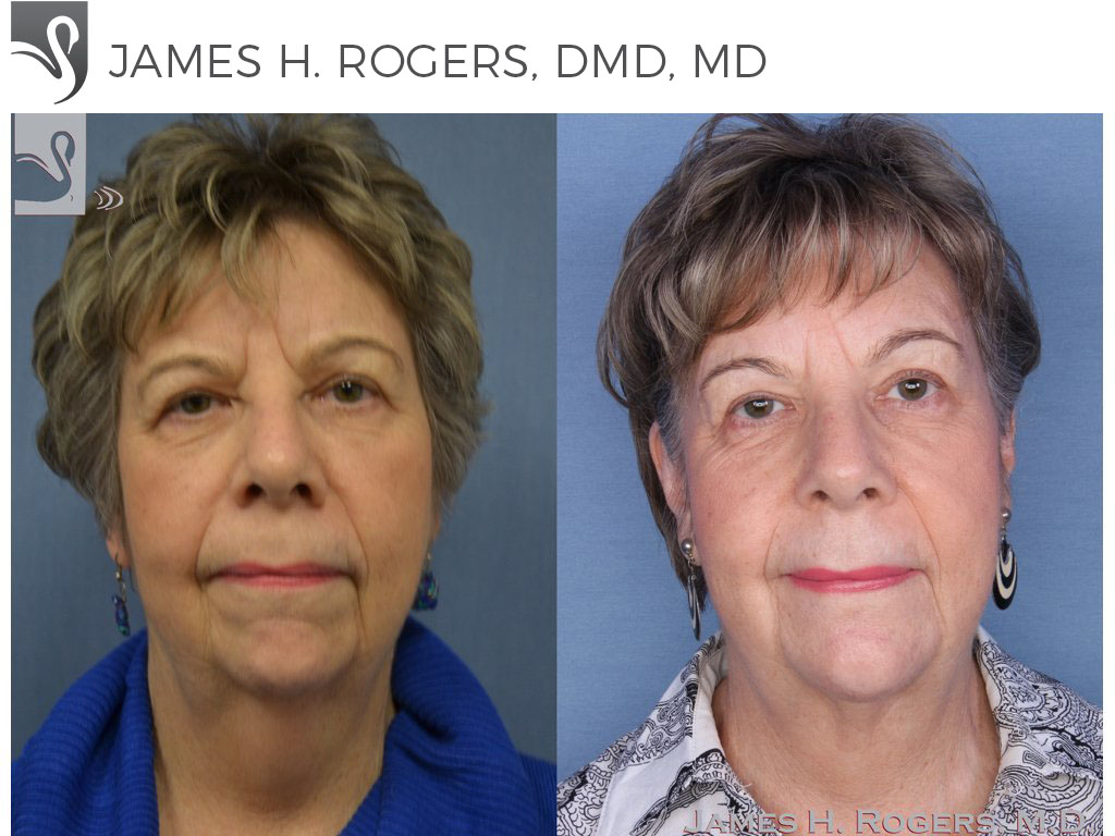 Before and After Image: Facial Implants Case #54918 - front