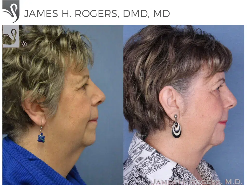 Before and After Image: Facial Implants Case #54918 - right-side