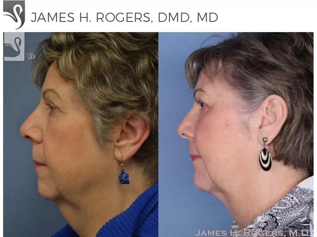 Before and After Image: Facial Implants Case #54918 - left-side