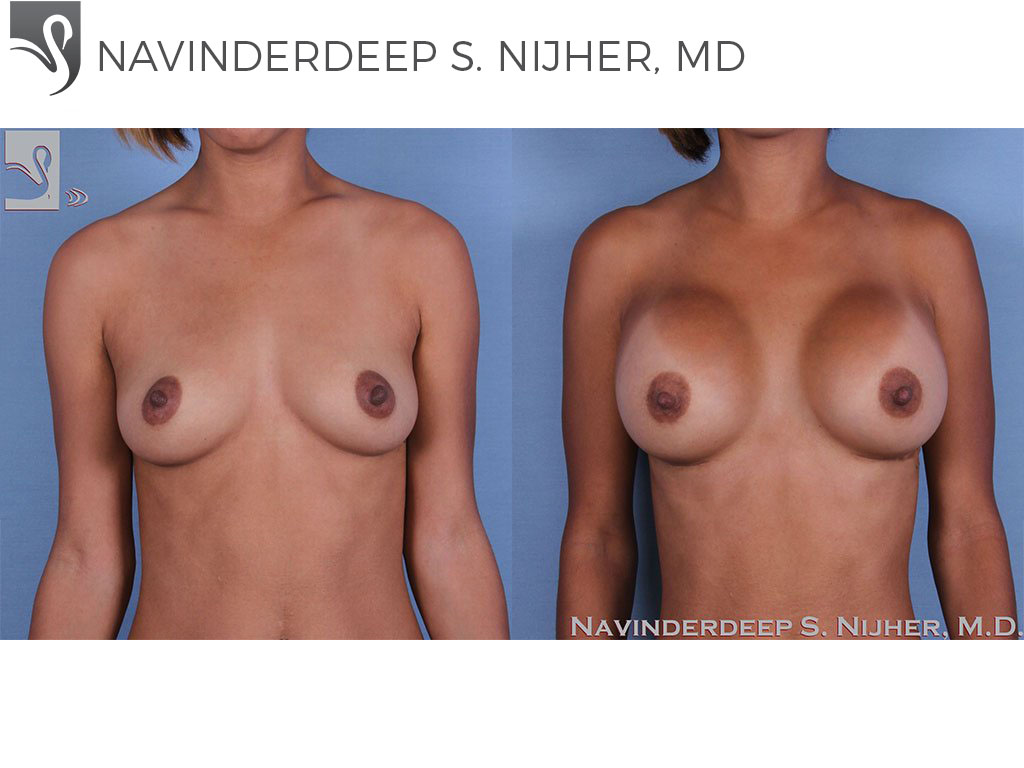 Before and After Image: Breast Augmentation Case #55028 - front