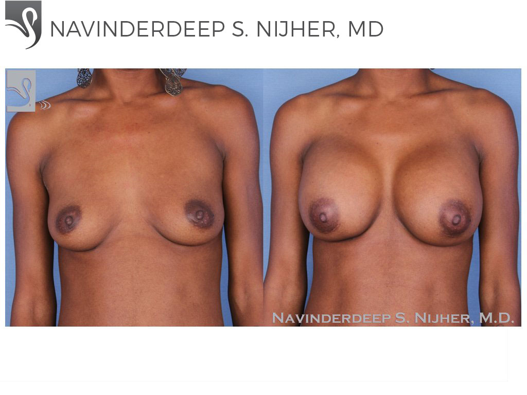 Before and After Image: Breast Augmentation Case #55093 - front