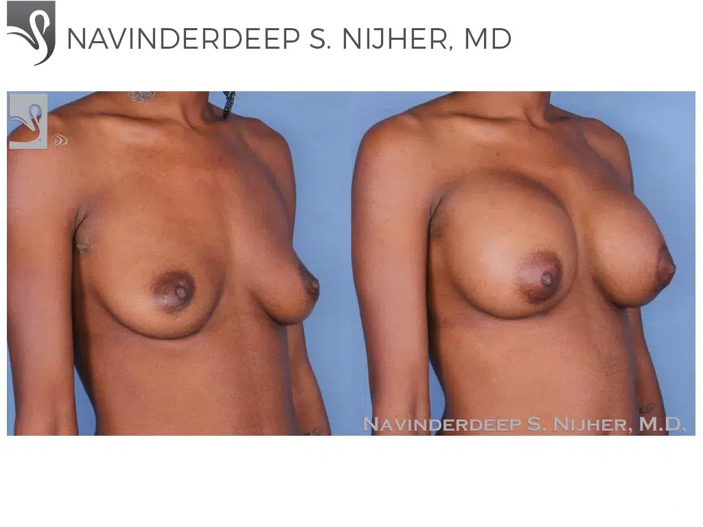 Before and After Image: Breast Augmentation Case #55093 - right-front-oblique