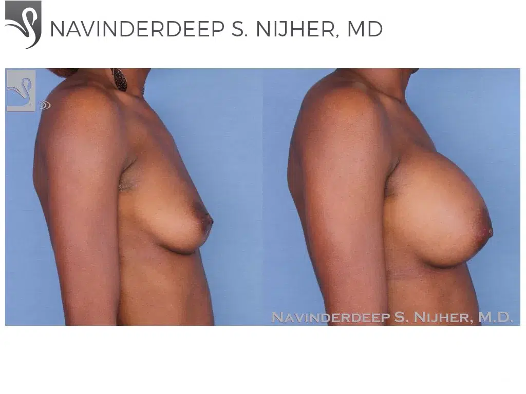 Before and After Image: Breast Augmentation Case #55093 - right-side