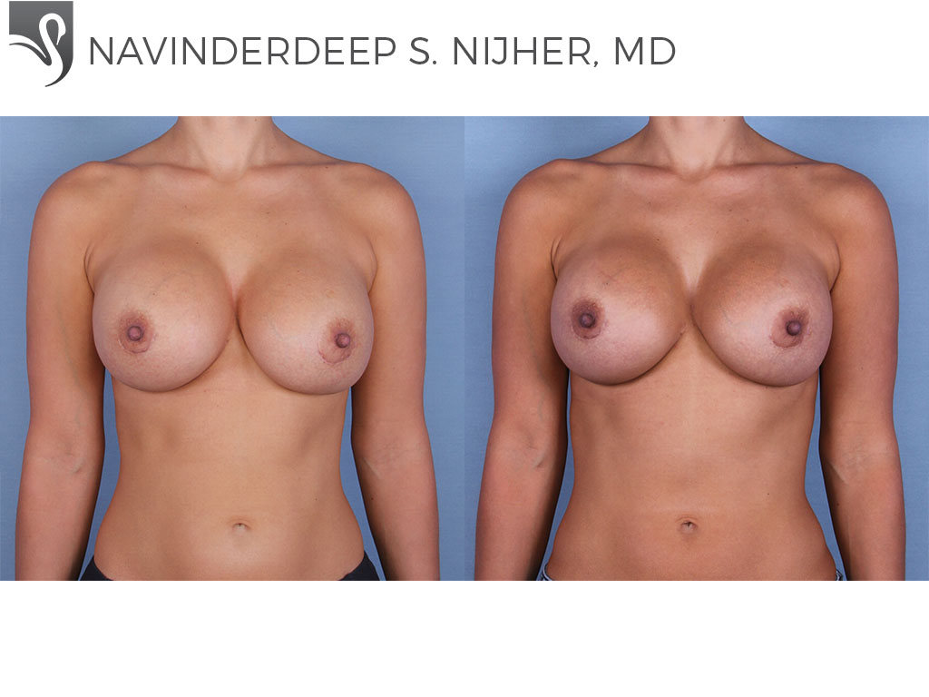 Before and After Image: Breast Revisions Case #55230 - front