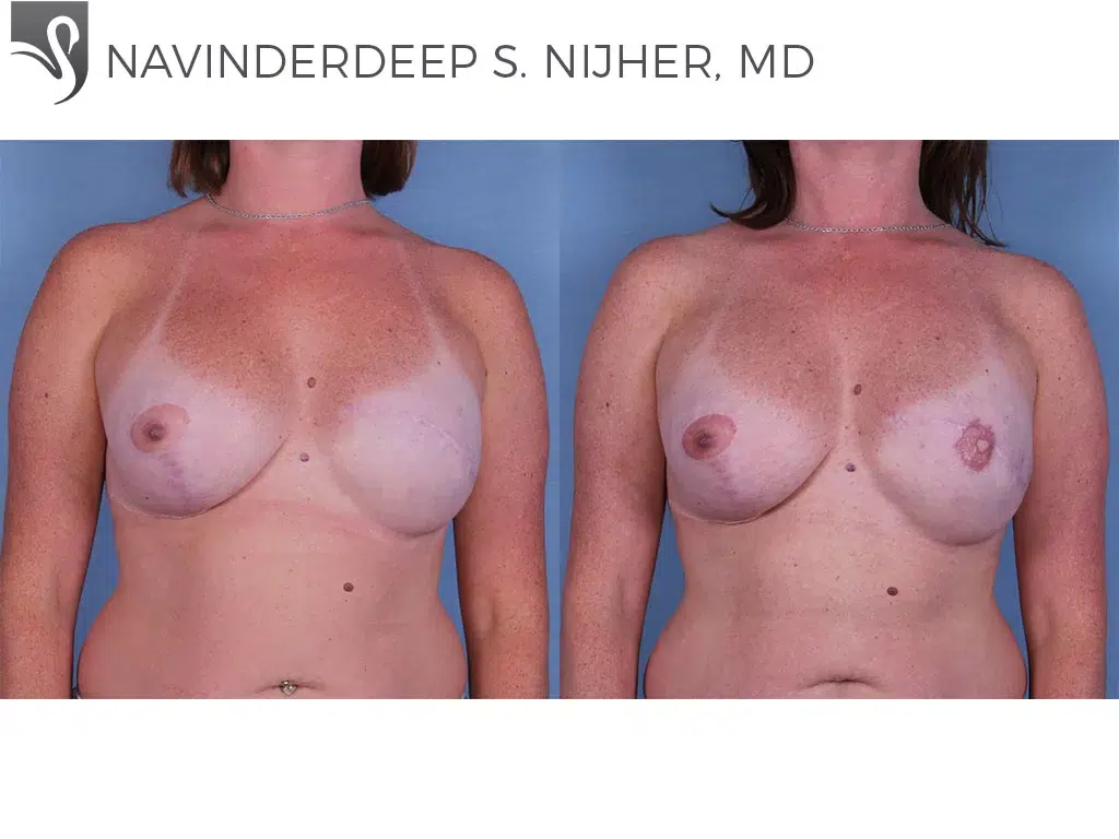 Before and After Image: Breast Reconstruction Case #55317