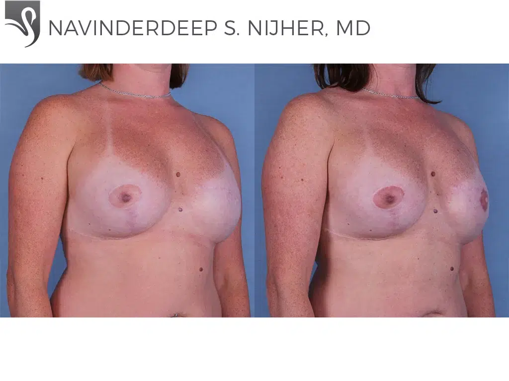 Before and After Image: Breast Reconstruction Case #55317 - right-front-oblique