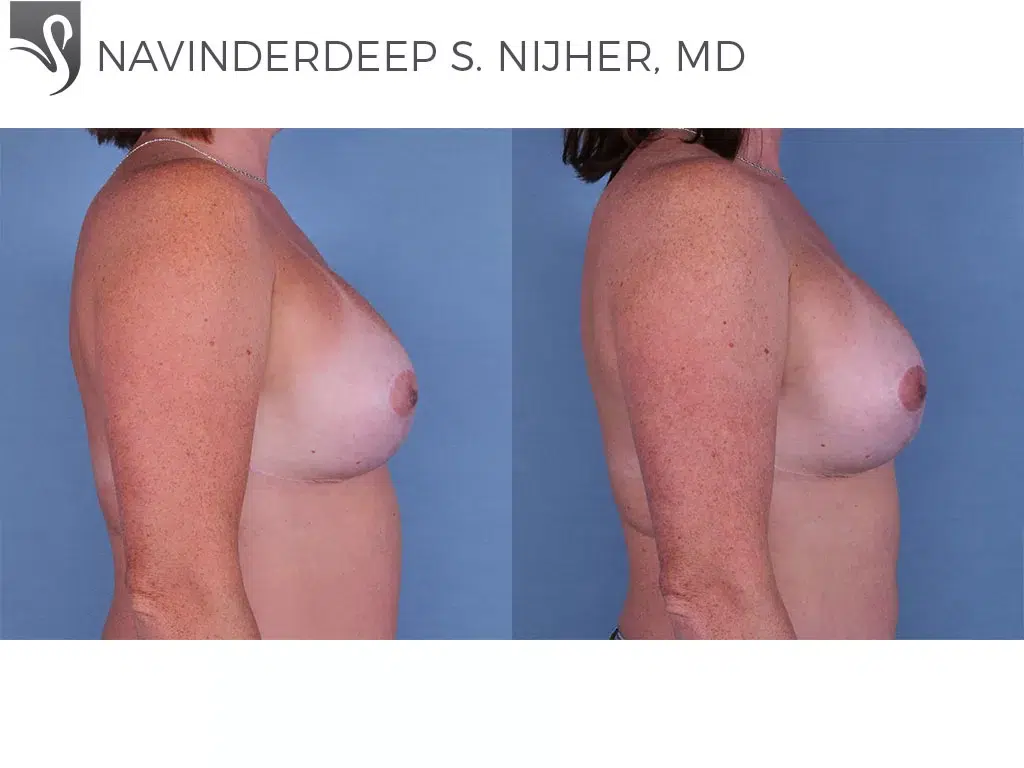 Before and After Image: Breast Reconstruction Case #55317 - right-side