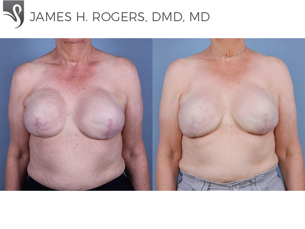 Before and After Image: Breast Reconstruction Case #55453