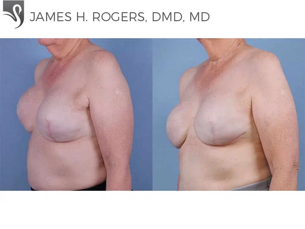 Before and After Image: Breast Reconstruction Case #55453 - left-front-oblique