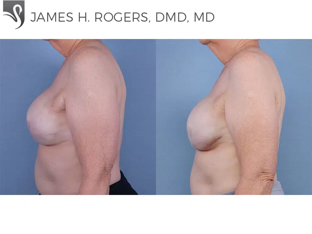 Before and After Image: Breast Reconstruction Case #55453 - left-side
