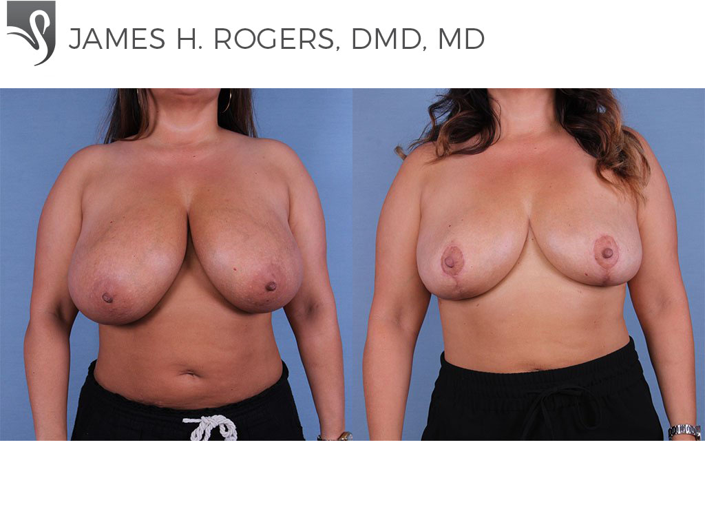 Before and After Image: Female Breast Reduction Case #55476 - front