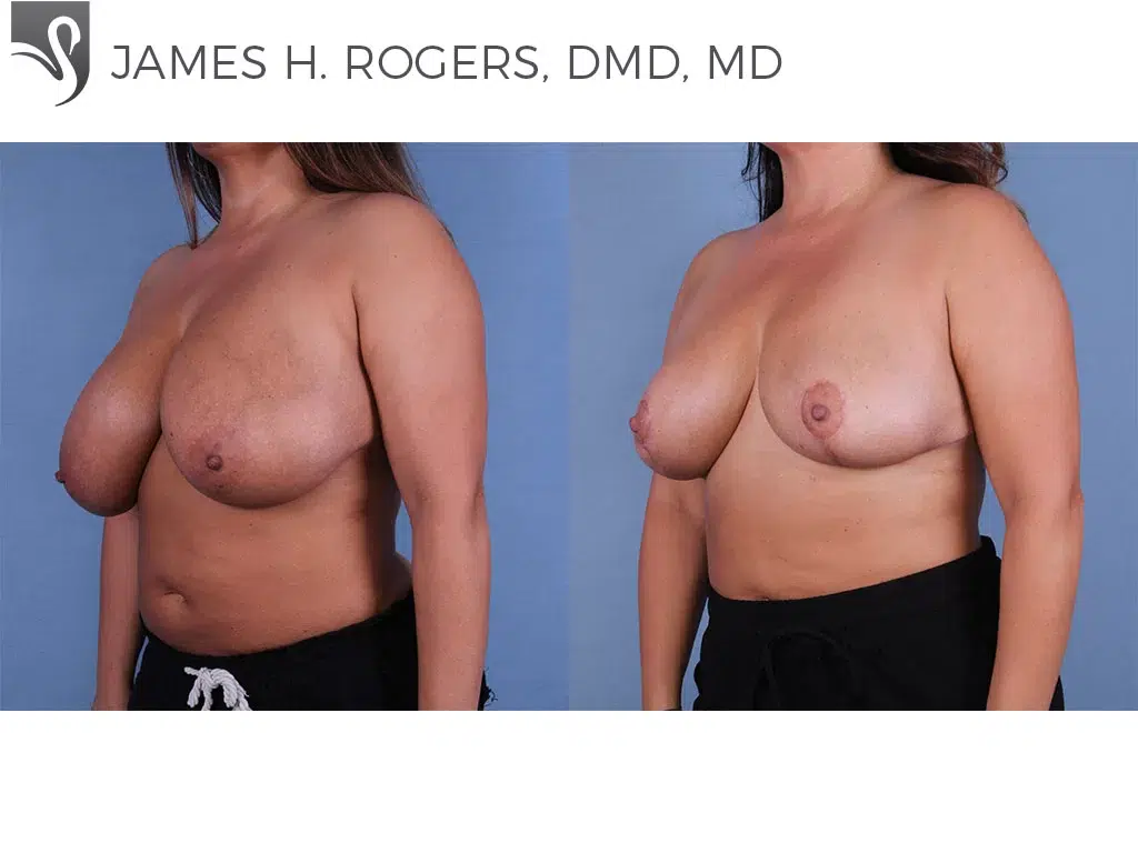 Before and After Image: Female Breast Reduction Case #55476 - left-front-oblique