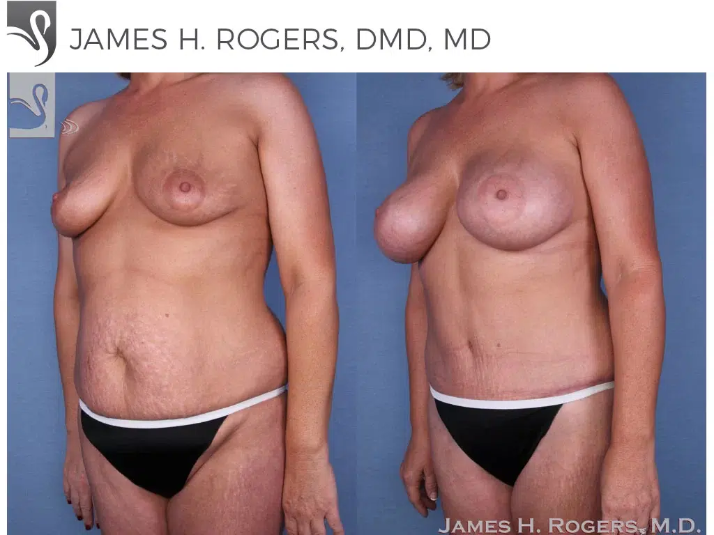 Before and After Image: Mommy Makeover Case #55657 - left-front-oblique