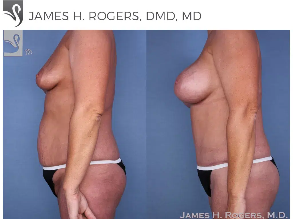 Before and After Image: Mommy Makeover Case #55657 - left-side