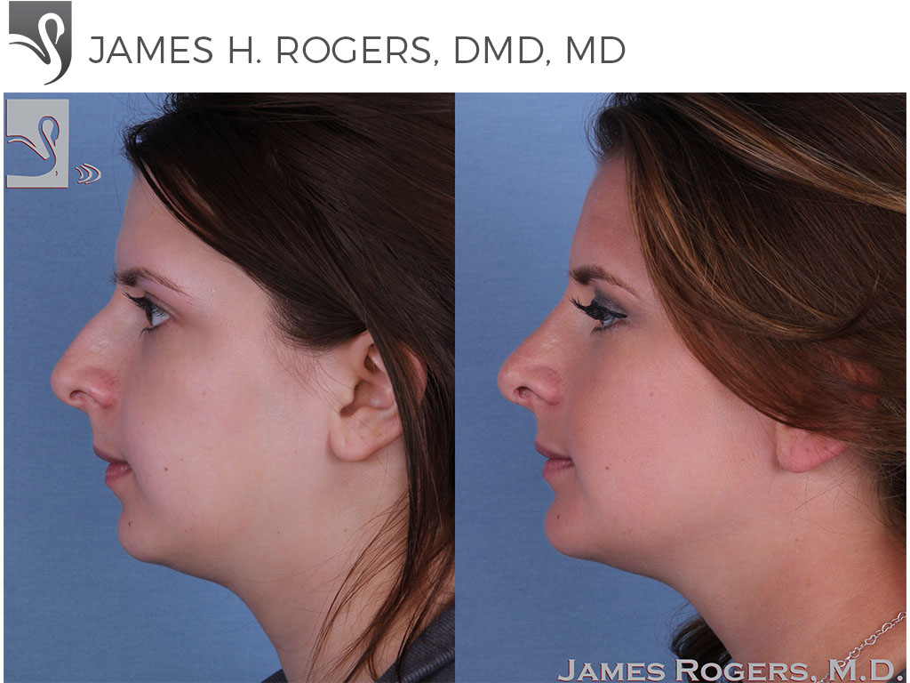 Before and After Image: Rhinoplasty Case #55949