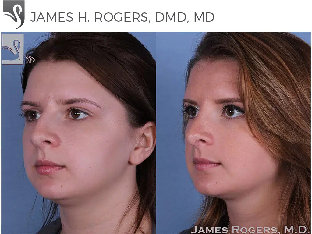 Before and After Image: Rhinoplasty Case #55949 - left-front-oblique