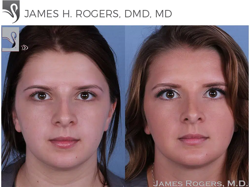 Before and After Image: Rhinoplasty Case #55949 - 