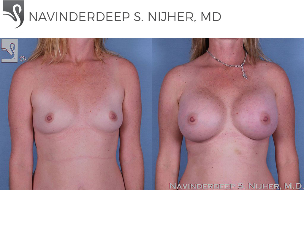 Before and After Image: Breast Augmentation Case #56127 - front