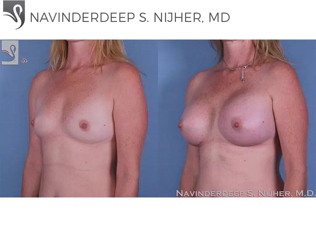 Before and After Image: Breast Augmentation Case #56127 - left-front-oblique