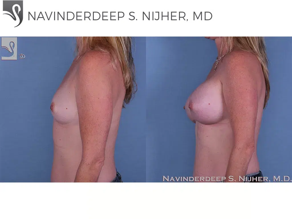 Before and After Image: Breast Augmentation Case #56127 - left-side