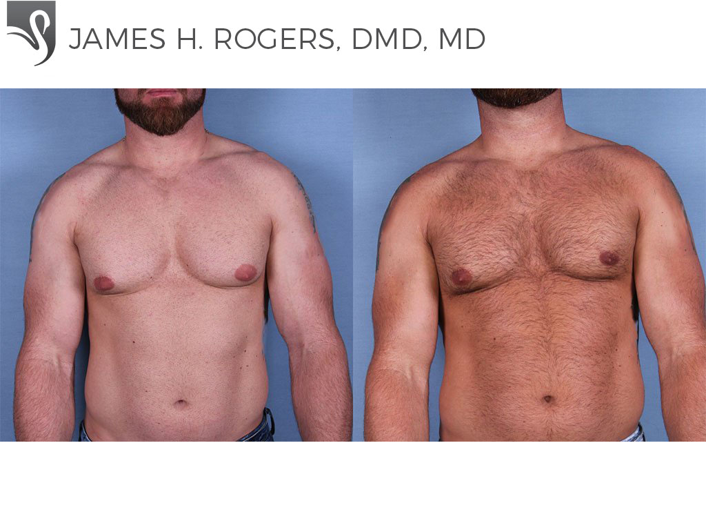 Before and After Image: Male Breast Reduction Case #56146 - front