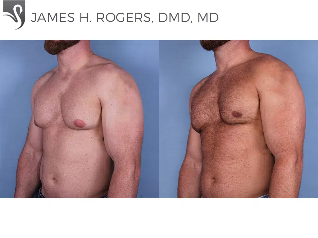 Before and After Image: Male Breast Reduction Case #56146 - left-front-oblique