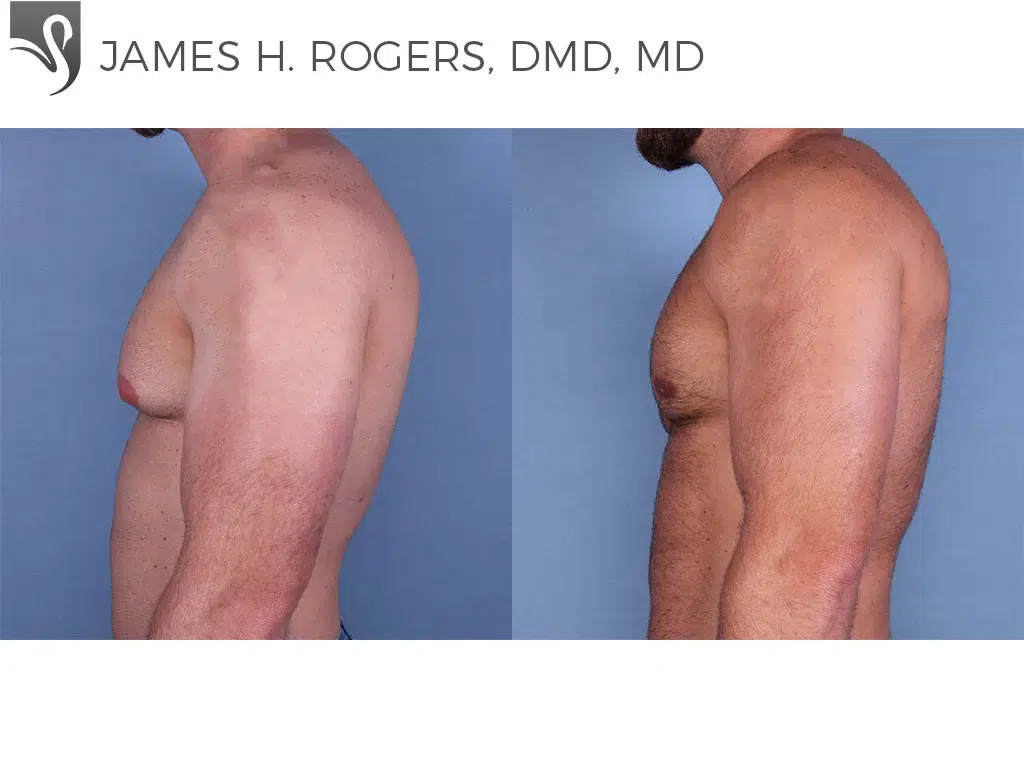 Before and After Image: Male Breast Reduction Case #56146 - left-side