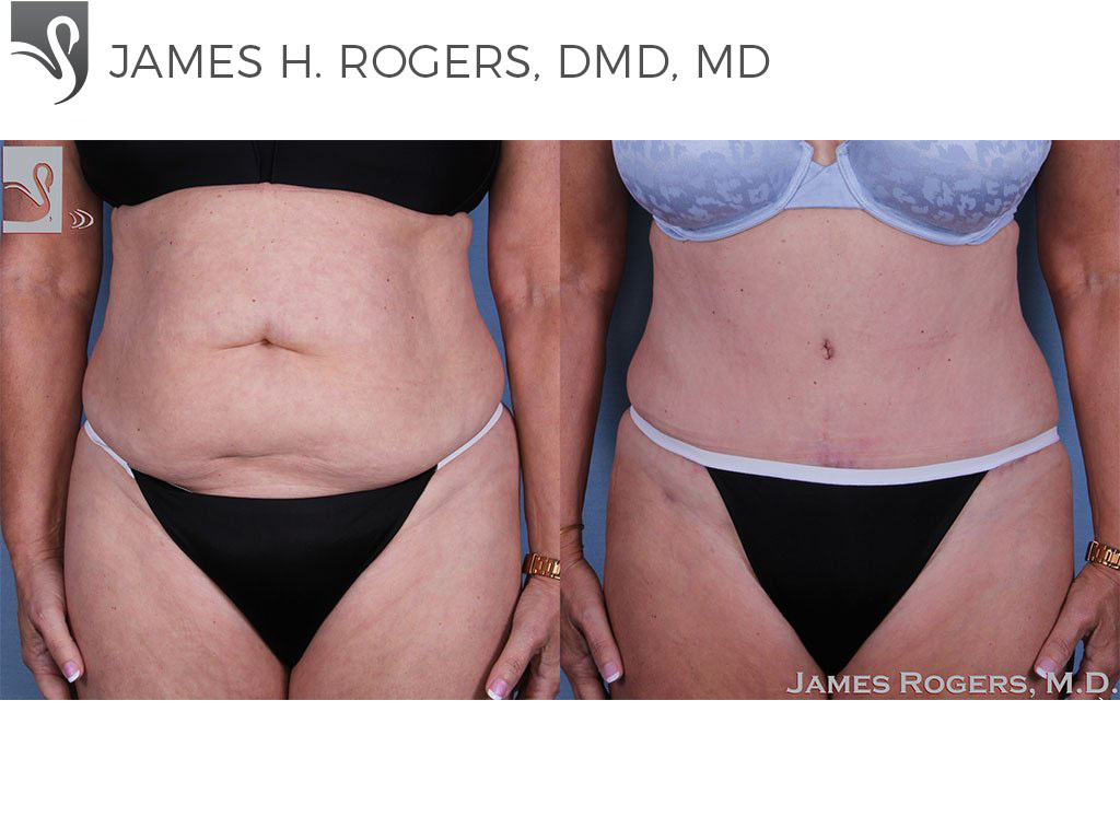 Before and After Image: Abdominoplasty (Tummy Tuck) Case #56207 - front