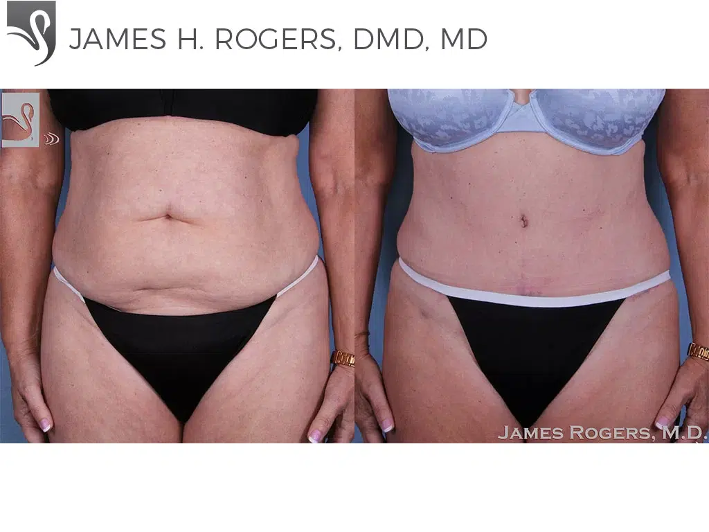 Before and After Image: Abdominoplasty (Tummy Tuck) Case #56207 - front