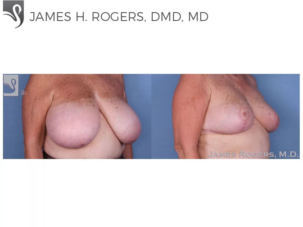 Before and After Image: Female Breast Reduction Case #56225 - right-front-oblique