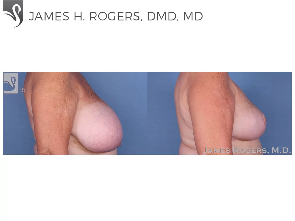 Before and After Image: Female Breast Reduction Case #56225 - right-side