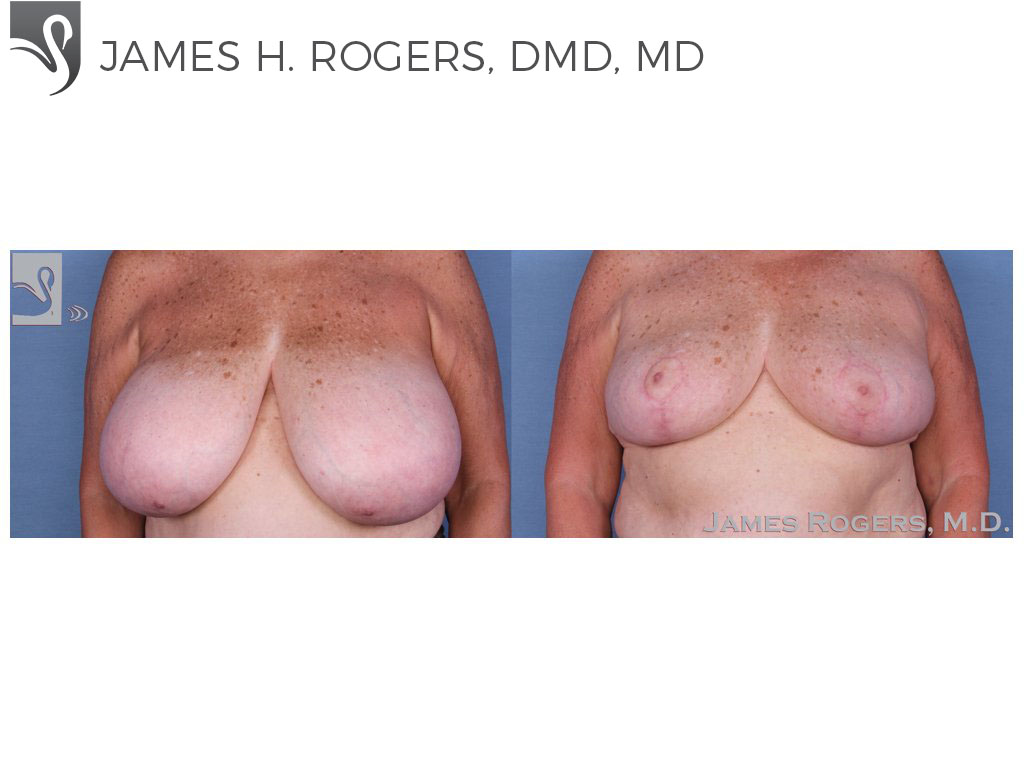 Before and After Image: Female Breast Reduction Case #56225 - front
