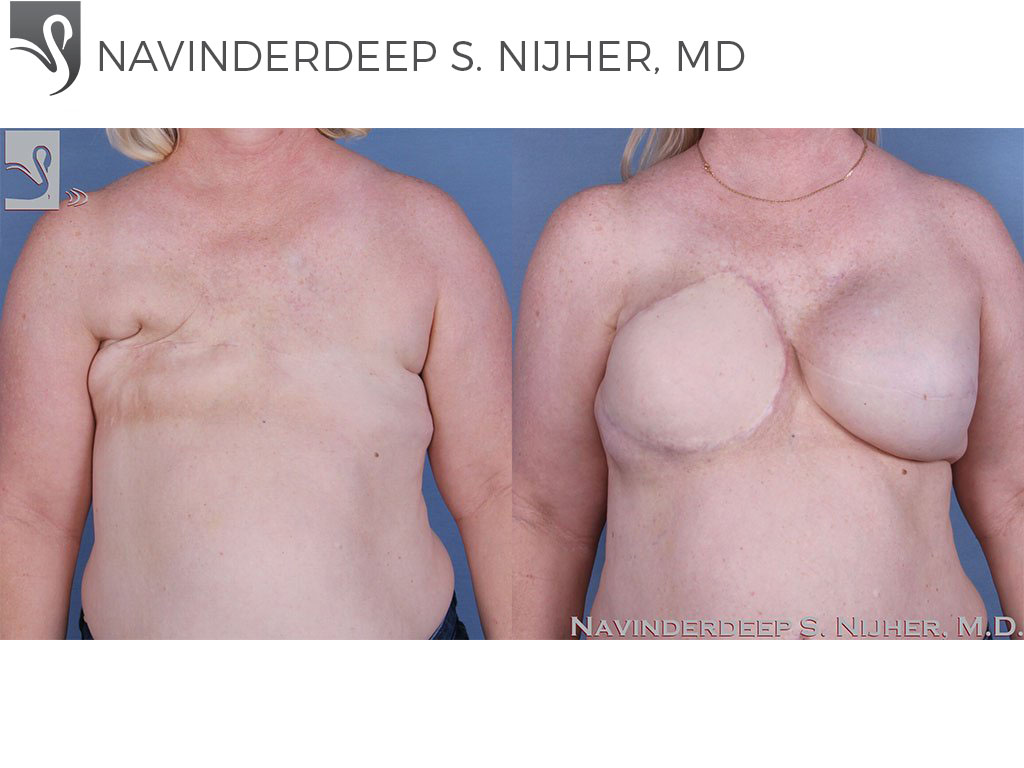 Before and After Image: Breast Reconstruction Case #56719 - front