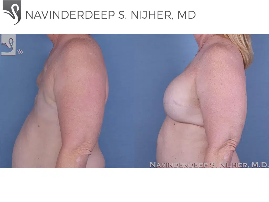 Before and After Image: Breast Reconstruction Case #56719 - left-side
